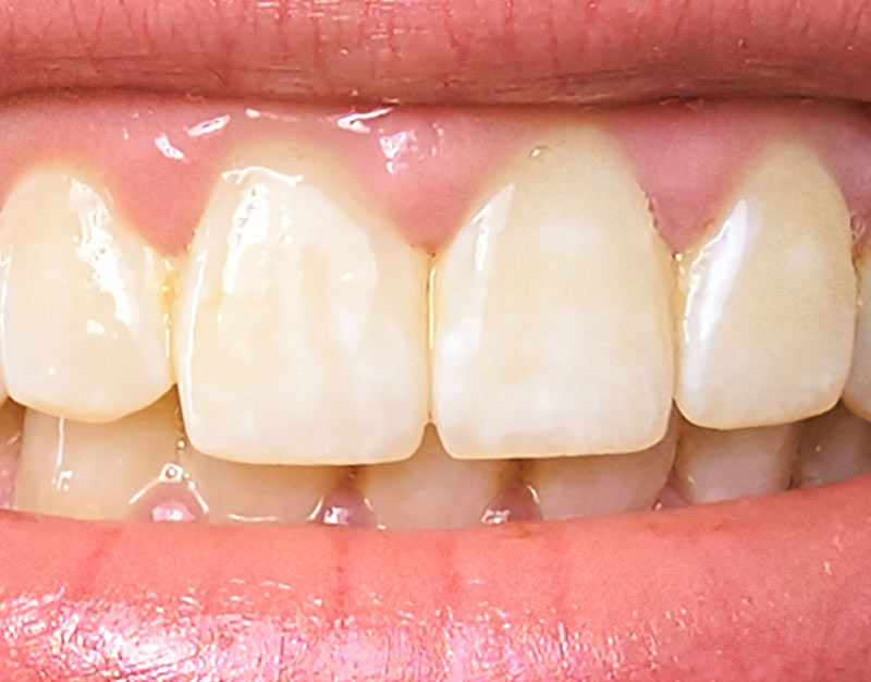 After Whitening Before Whitening