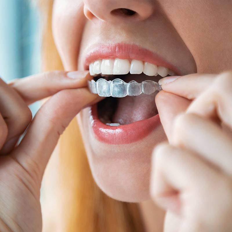 Ask Your New Caney Dentist: Should I Get Metal or Clear Braces?